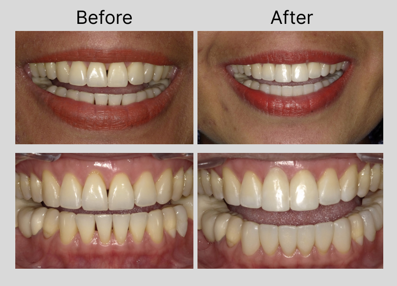 Chairside Composite Veneers Chandler, AZ Anantuni Family Dental